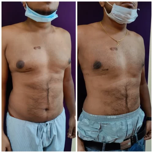 Gynecomastia Treatment Results - Venkat Center Bangalore 4