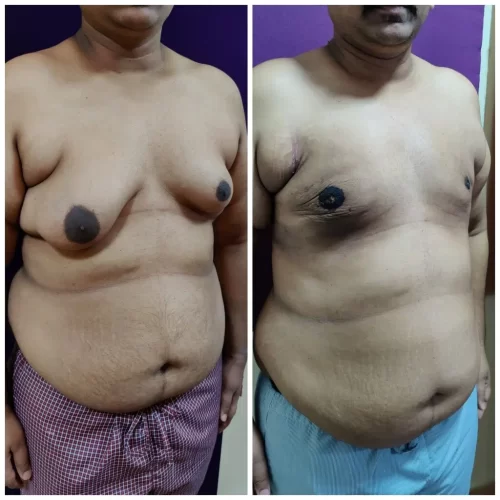 Gynecomastia Treatment Results - Venkat Center Bangalore 5