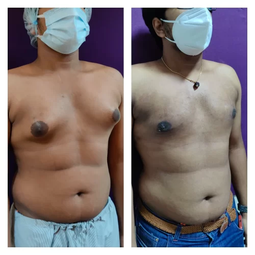 Gynecomastia Treatment at The Venkat Center