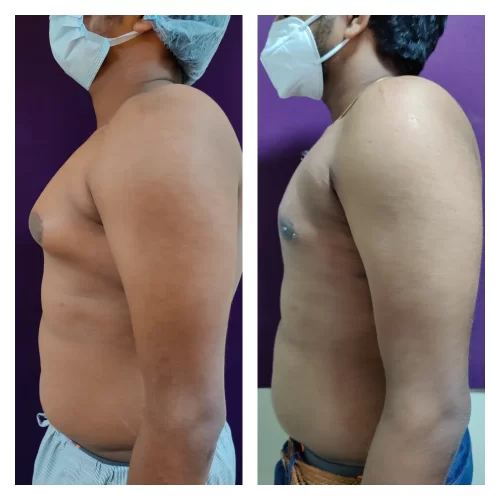 Gynecomastia Treatment at The Venkat Center