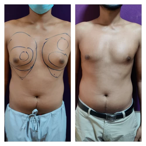 Gynecomastia Treatment at The Venkat Center
