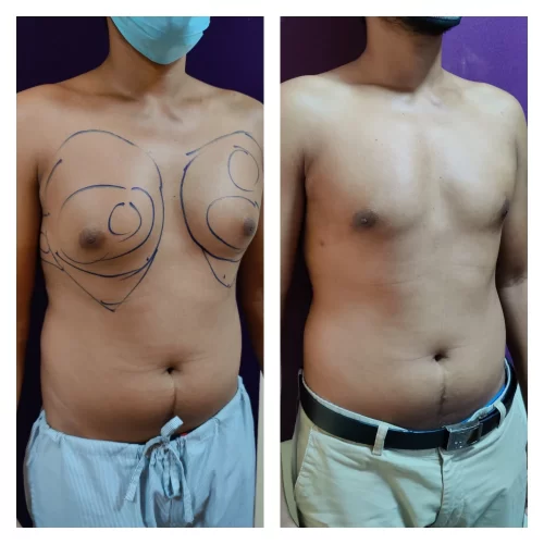 Gynecomastia Treatment at The Venkat Center