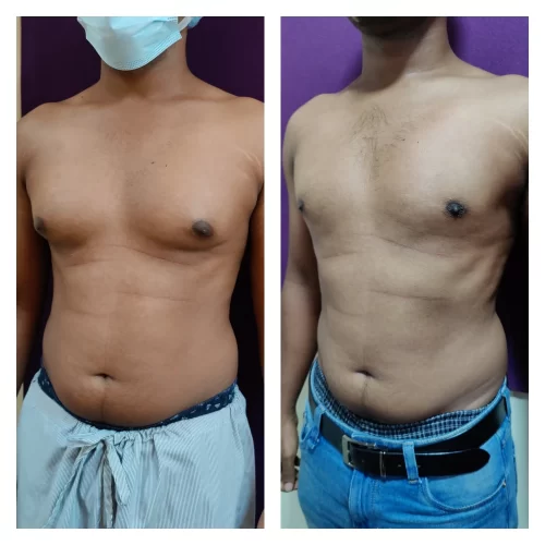 Gynecomastia results at The Venkat Center 1