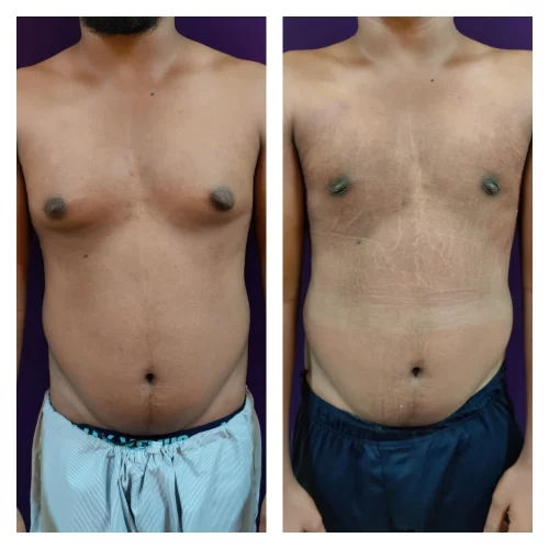 Gynecomastia results at The Venkat Center 2