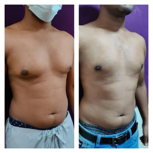 Gynecomastia results at The Venkat Center