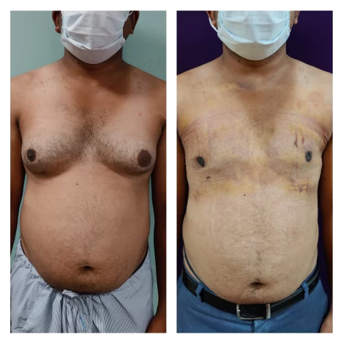 Gynecomastia Surgery results at Venkat Center, Bangalore