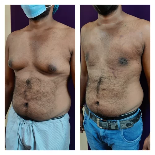 Gynecomastia results - at Venkat Center, Bangalore
