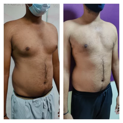 Gynecomastia results - at Venkat Center, Bangalore