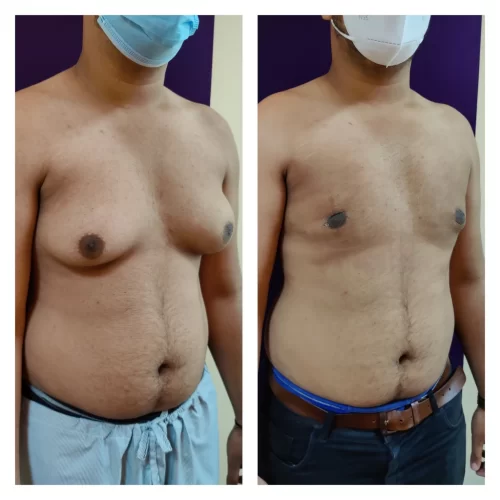 Gynecomastia results - at Venkat Center, Bangalore