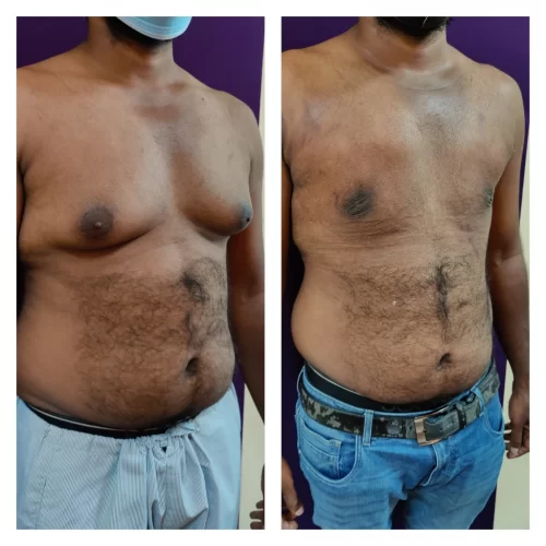 Gynecomastia results - at Venkat Center, Bangalore