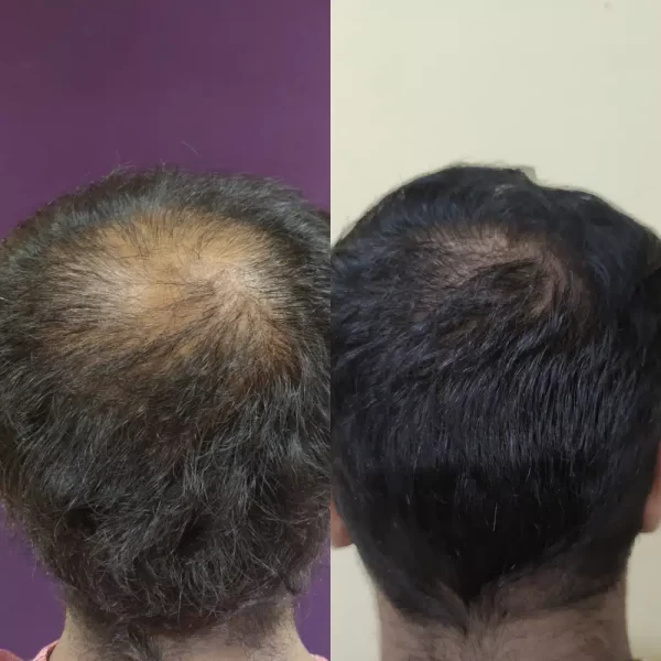 Hair Transplant results at Venkat Center, Bangalore