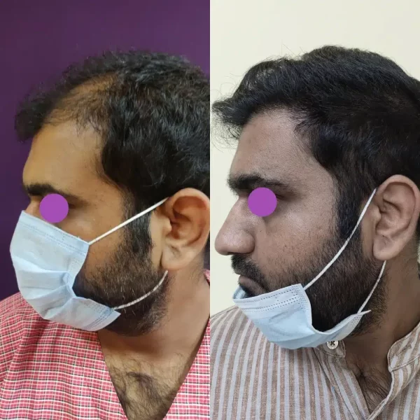 Hair Transplant results at Venkat Center, Bangalore