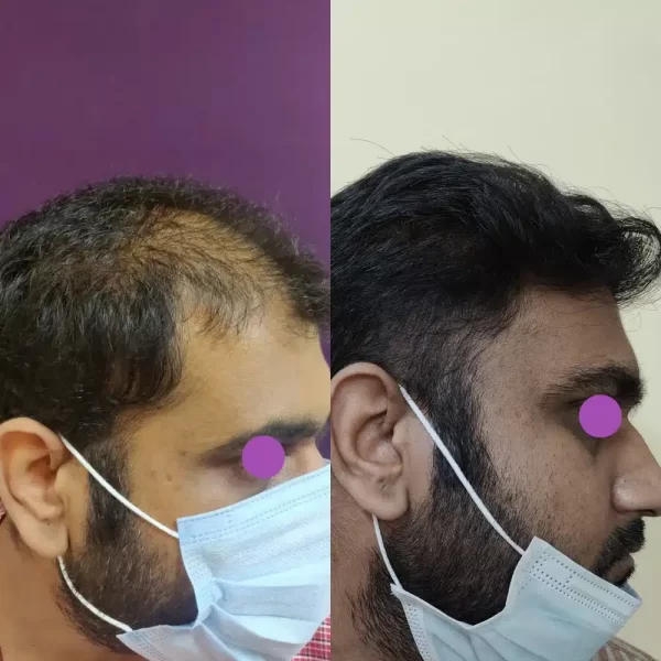 hair transplant in bangalore
