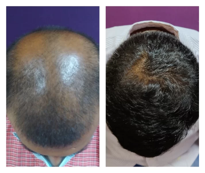 Hair Transplant results - at Venkat Center, Bangalore