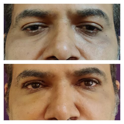 blepharoplasty-4