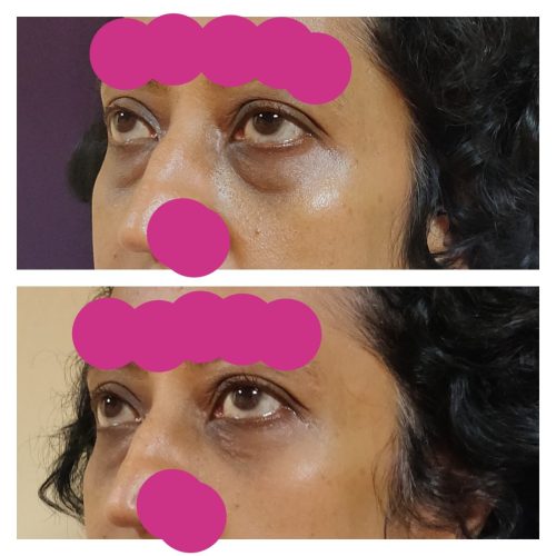 blepharoplasty-result
